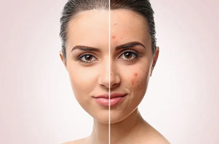  بهترین کرم ضد جوش صورت برای هر نوع پوست