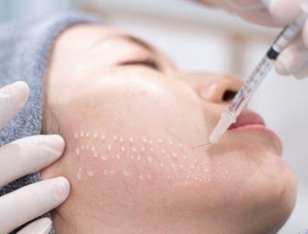 میزان تزریق در هر جلسه مزوتراپی چقدر است؟