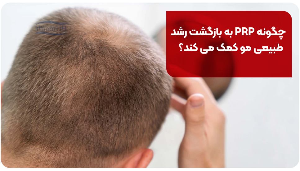 چگونه PRP به بازگشت رشد طبیعی مو کمک می‌ کند؟