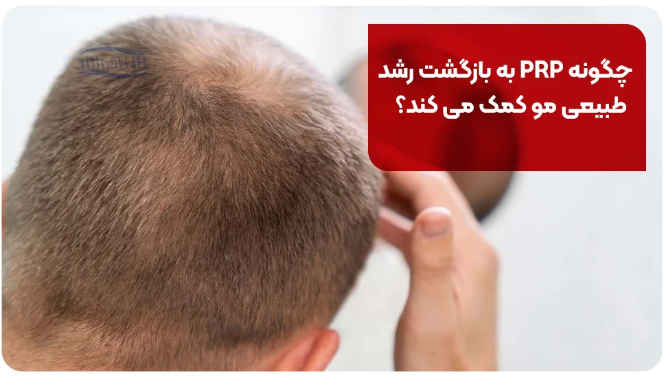 پوست چگونه PRP به بازگشت رشد طبیعی مو کمک می کند؟