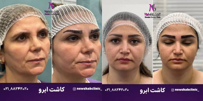 راز داشتن ابروهای پرپشت و طبیعی با کاشت ابرو دائمی